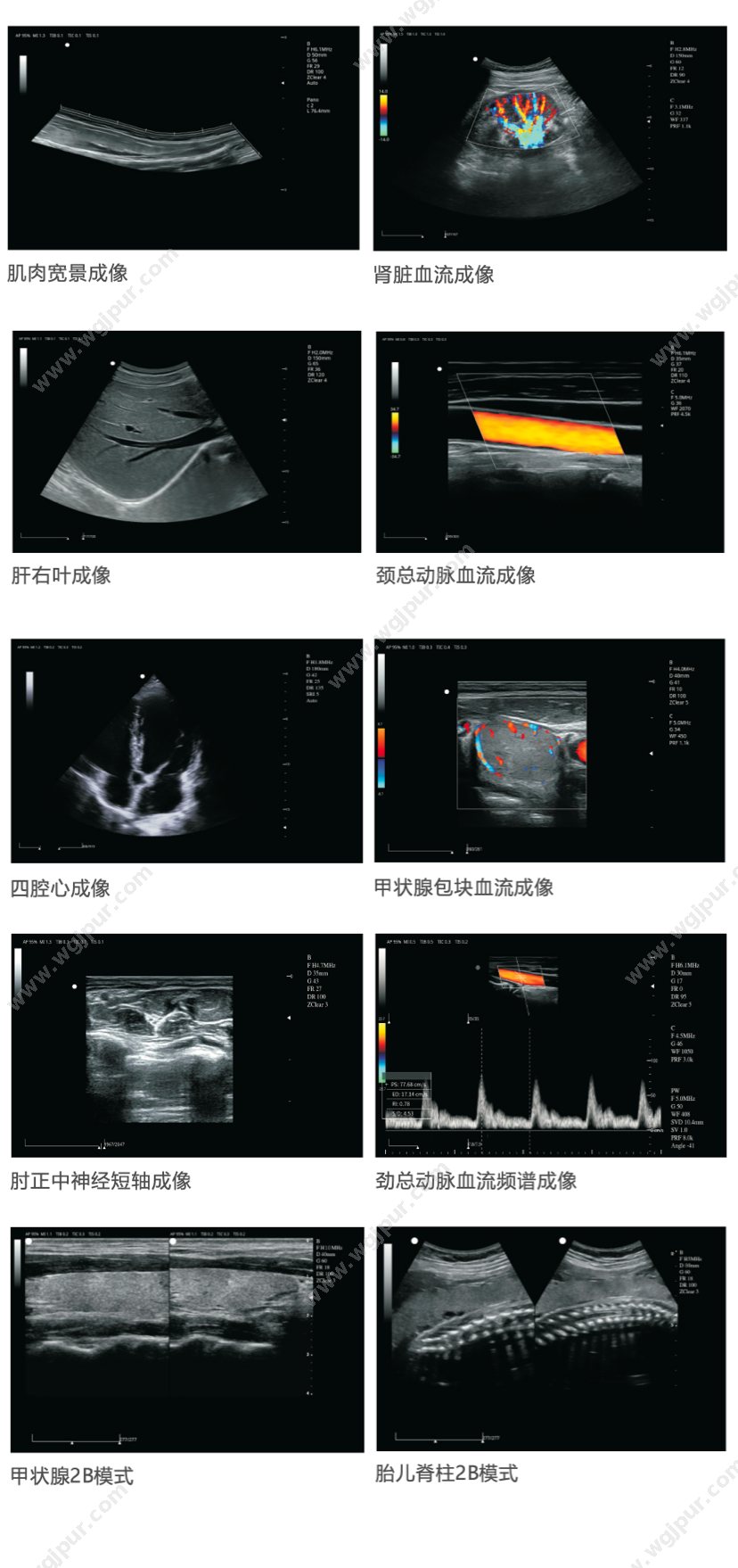 中旗医疗 V7 3C5PD凸阵 超声影像