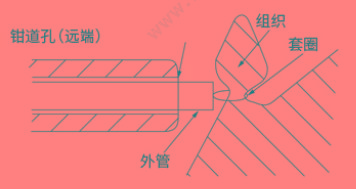 南微医学 MTN-PFS-E-36/23（10支/盒 10盒/箱） 一次性圈套器