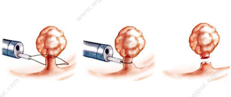 南微医学 一次性使用可旋转电圈套器 RS-E-20/18（10支/盒 10盒/箱） 一次性圈套器