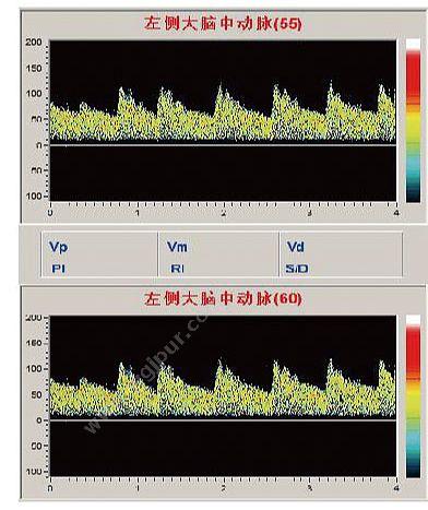 科进 Kejin 超声经颅多普勒血流分析仪 KJ-2V6M+ 经颅多普勒