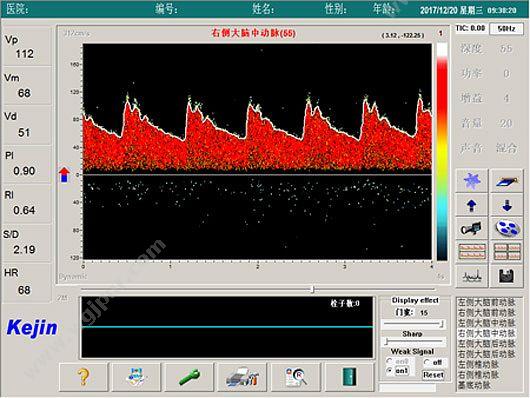 科进 Kejin 超声经颅多普勒血流分析仪 KJ-2V7M 经颅多普勒