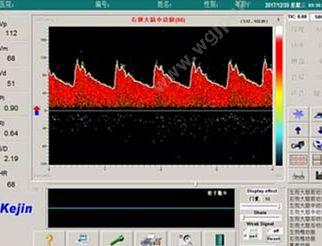 科进 Kejin 超声经颅多普勒血流分析仪 KJ-2V6M 经颅多普勒