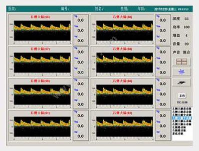 科进 Kejin 超声经颅多普勒血流分析仪 KJ-2V6M 经颅多普勒